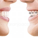 invisalign