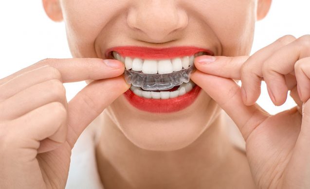 ORTODONCIA SÍN BRACKETS